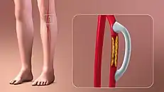 3D Medical Animation still shot depicting the Vascular Bypass Grafting