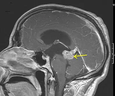 Low grade astrocytoma of the midbrain (lamina tecti), sagittal T1-weighted magnetic resonance imaging after contrast medium administration: The tumor is marked with an arrow. The CSF spaces in front of the tumor are expanded due to compression-induced hydrocephalus internus.