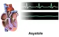 Asystole