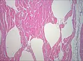 Muscle biopsy examined under the microscope (haematoxylin-eosin stain, zoom 100×): the large white areas between the muscle fibers are due to gas formation.