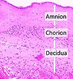 Acute choriodeciduitis, with neutrophils seen in the chorion and decidua.