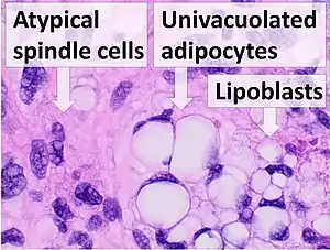 Histopathology of liposarcoma, H&E stain, with the main features:- Spindle cells with enlarged, hyperchromatic nuclei.- Apparently univacuolated adipocytes (may look normal).- Lipoblasts (multivacuolated), but neither necessary nor sufficient for diagnosis of liposarcoma.