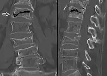 The intravertebral vacuum cleft sign (at white arrow) is a sign of avascular necrosis. Avascular necrosis of a vertebral body after a vertebral compression fracture is called Kümmel's disease.