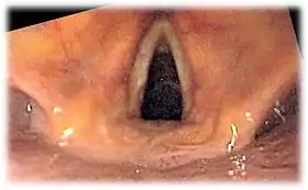 View of the glottis as seen during laryngoscopy