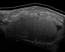 Fig. 16. Liposarcoma mimicking lipoma. A homogeneous hypoechoic mass presents with the same appearance of lipoma, rapid growth of this tumors grants surgical intervention with pathology proved to be well differentiated liposarcoma.[citation needed]