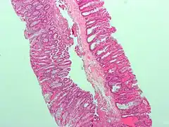 Micrograph of a sessile serrated adenoma. H&E stain.