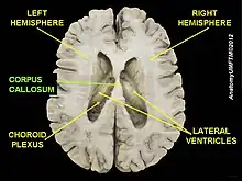  Corpus callosum