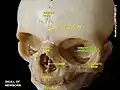 Greater wing of sphenoid bone