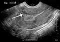 A small uterine fibroid seen within the wall of the myometrium on a cross-sectional ultrasound view