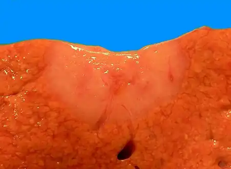 Gross pathologic appearance of a large bile duct hamartoma.